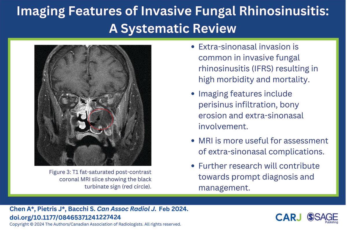 Check out this recently published #openaccess #systematicreview on the imaging features of invasive fungal rhinosinusitis: doi.org/10.1177/084653… @CARadiologists @SageJournals #radiology #mri #radres