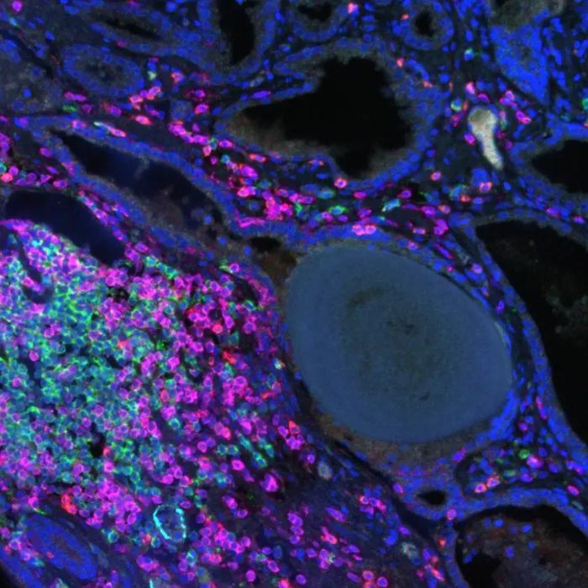 Today's #TissueTuesday showcases #prostatecancer FFPE tissue stained with an Opal 6-plex panel (CD4, CD8, CD19, CD21, DC-LAMP, and PNAd), revealing a Type V #tertiarylymphoidstructures (TLS).

Thank you, @JessDGDuarte, for using our #PhenoImager solution to generate this