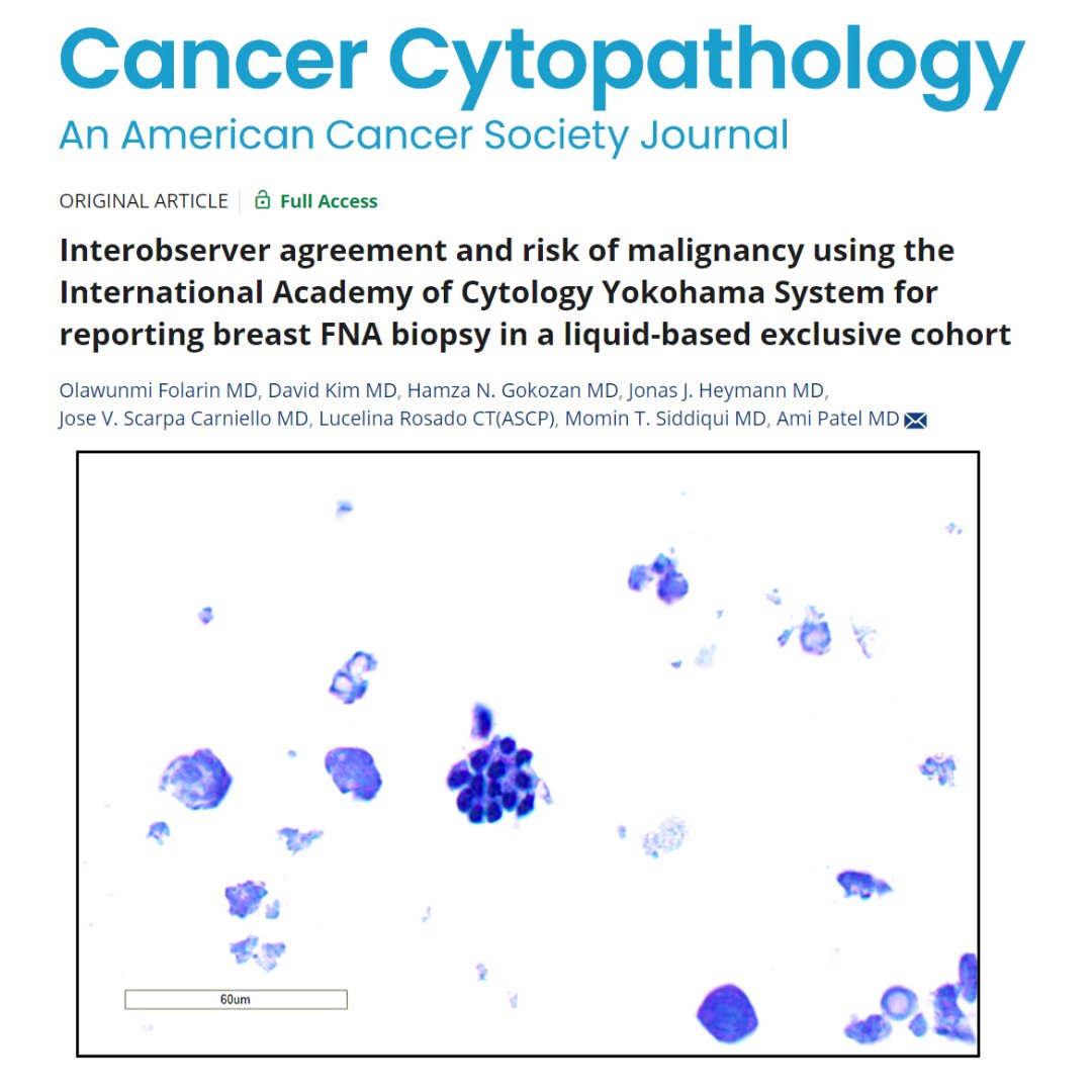 Cancer Cytopathology (@cancercytopath) on Twitter photo Hot off the press 📰🔬 | The authors conclude that interobserver agreement is excellent using the 5 Yokohama System categories in liquid-based cytology.
acsjournals.onlinelibrary.wiley.com/doi/full/10.10…
<a href="/efohess/">Ola Folarin,MD</a> <a href="/mtsiddi/">Momin Siddiqui</a> #CytoPath Hot off the press 📰🔬 | The authors conclude that interobserver agreement is excellent using the 5 Yokohama System categories in liquid-based cytology.
acsjournals.onlinelibrary.wiley.com/doi/full/10.10…
<a href="/efohess/">Ola Folarin,MD</a> <a href="/mtsiddi/">Momin Siddiqui</a> #CytoPath