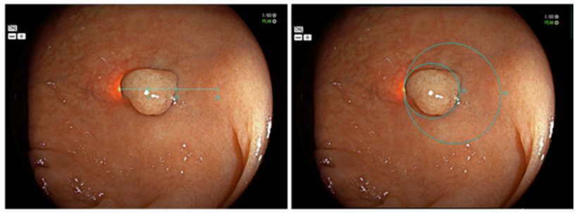 tberzin's tweet photo. 510k clearance for first automated polyp-measurement tool, SCALE EYE by @FujifilmUS.  Requires BOTH a laser-equipped colonoscope + computer vision software.  Provides a linear or circular virtual measurement.  
https://t.co/IPevRTmhO3 https://t.co/u17uHaV2af