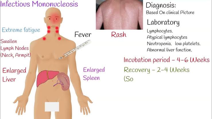 Mono Rashes Amoxicillin Rash Mononucleosis Treatment