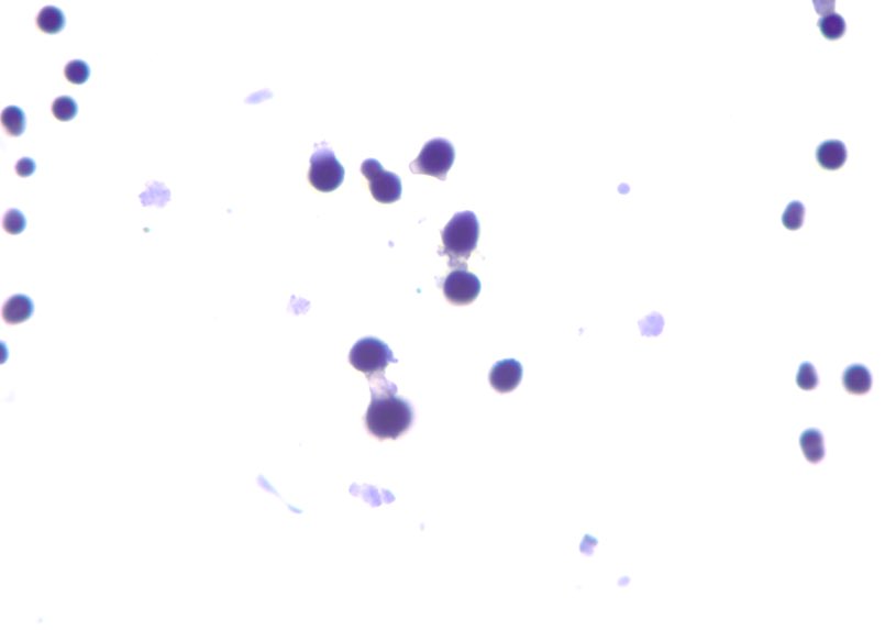Hi #PathX 👋 

What do you see in these 🧐 CSF cytology pictures👇?! 

#PathX #PathTwitter #CytoX #CytoPath #Cytology