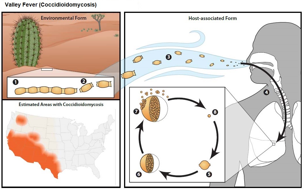 #InfectiousDiseaseInTheNews Cases of Valley Fever, a fungus that lives in dust and soil, are increasingly reported in areas of the southwestern US. Infection occurs when fungal spores spread through the air after contaminated soil and dust are disturbed. Anyone can get Valley⬇️
