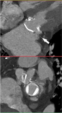 Tiffany Chen (@tiffchenmd) on Twitter photo <a href="/EGarciaSayan/">Enrique Garcia-Sayan, MD, FACC, FASE</a> <a href="/ASE360/">American Society of Echocardiography</a> <a href="/WilliamZoghbi/">WilliamZoghbi</a> <a href="/hahn_rt/">RTHahnMD</a> <a href="/NadeenFaza/">Nadeen N. Faza, M.D.</a> <a href="/purviparwani/">Dr. Purvi Parwani</a> <a href="/iamritu/">Ritu Thamman MD</a> <a href="/ChamsiPash/">Mohammed Chamsi Pasha, FACC, FASE</a> <a href="/onco_cardiology/">Juan Lopez-Mattei, MD</a> <a href="/rajdoc2005/">Raj Janardhanan, MD, MRCP, FACC, FASE</a> <a href="/ash71us/">Ashish Aneja MD FACC FAHA FASE FSCMR</a> <a href="/JournalASEcho/">JASE</a> <a href="/Heart_SCCT/">Heart_SCCT</a> Examples of #yesCCT assessment of prosthetic valve dysfunction - table of features to distinguish between them, calcification, pannus, and dehiscence. #ASEchoJC
pubmed.ncbi.nlm.nih.gov/35183554/
<a href="/selma_carlson/">Selma Carlson MD</a> <a href="/JoaoLCavalcante/">João Cavalcante</a> <a href="/JonathonLeipsic/">Jonathon Leipsic</a> <a href="/Heart_SCCT/">Heart_SCCT</a> <a href="/EGarciaSayan/">Enrique Garcia-Sayan, MD, FACC, FASE</a> <a href="/ASE360/">American Society of Echocardiography</a> <a href="/WilliamZoghbi/">WilliamZoghbi</a> <a href="/hahn_rt/">RTHahnMD</a> <a href="/NadeenFaza/">Nadeen N. Faza, M.D.</a> <a href="/purviparwani/">Dr. Purvi Parwani</a> <a href="/iamritu/">Ritu Thamman MD</a> <a href="/ChamsiPash/">Mohammed Chamsi Pasha, FACC, FASE</a> <a href="/onco_cardiology/">Juan Lopez-Mattei, MD</a> <a href="/rajdoc2005/">Raj Janardhanan, MD, MRCP, FACC, FASE</a> <a href="/ash71us/">Ashish Aneja MD FACC FAHA FASE FSCMR</a> <a href="/JournalASEcho/">JASE</a> <a href="/Heart_SCCT/">Heart_SCCT</a> Examples of #yesCCT assessment of prosthetic valve dysfunction - table of features to distinguish between them, calcification, pannus, and dehiscence. #ASEchoJC
pubmed.ncbi.nlm.nih.gov/35183554/
<a href="/selma_carlson/">Selma Carlson MD</a> <a href="/JoaoLCavalcante/">João Cavalcante</a> <a href="/JonathonLeipsic/">Jonathon Leipsic</a> <a href="/Heart_SCCT/">Heart_SCCT</a>