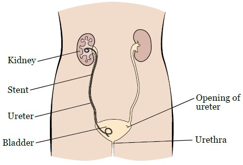 Two methods of renal drainage for upper tract obstruction: 1. Percutaneous nephrostomy tube 2. Indwelling ureteral stent Literature shows no difference in health-related quality of life when comparing the two; however, clinical context must be considered when choosing.