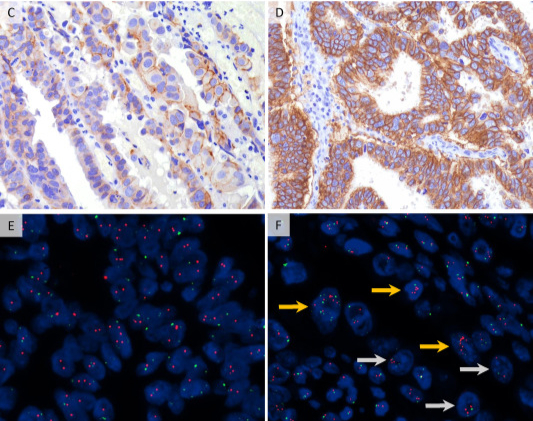 Pathology_RCPA's tweet photo. For an overview of key predictive and prognostic markers for common gynaecological #cancers, with practical implications for #pathologists and clinicians, see this article in the March issue of #Pathology ➡️ https://t.co/TC9LsQSvV8 #PathTwitter #MedTwitter #MedEd #gynpath https://t.co/HSV8dp4kdq