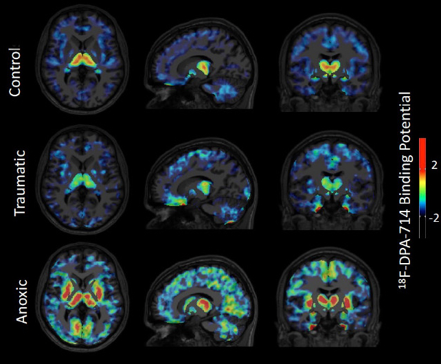 Sarton et al. investigate the relationship between neuroinflammation – measured in vivo using TSPO PET – and neurological outcomes in patients with coma following cardiac arrest or traumatic brain injury. tinyurl.com/2hbmreyy