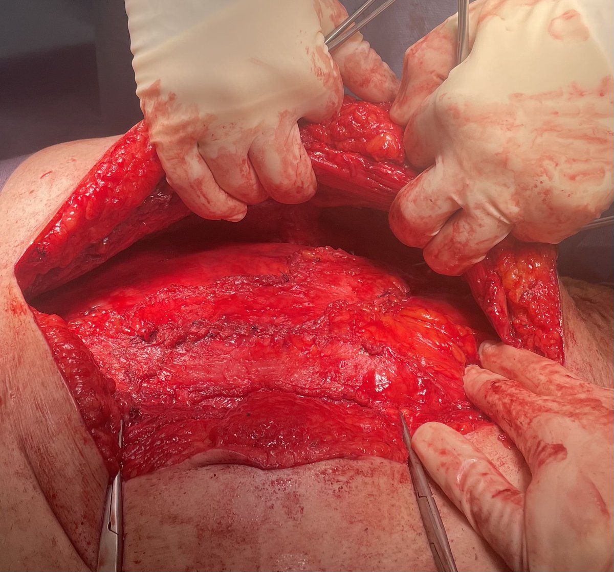 Good @jeffblatnik trick for closing large peritoneal defects during TAR-posterior rectus sheath rotation. In the words of the master “complex solutions for simple problems- just fixing holes”