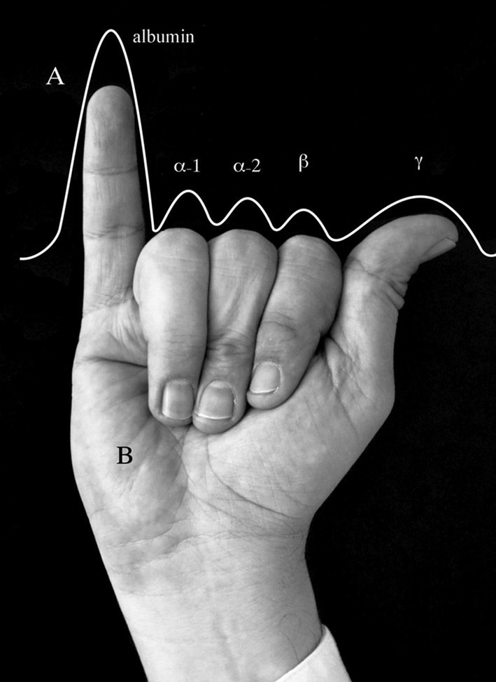 An easy way to remember serum protein electrophoresis for #MedstudentTwitter ! In myeloma, the thumb goes ⤴️ and the pinky finger goes ⤵️ To know more than this, follow along 👇🏼 #MedTwitter 1/16