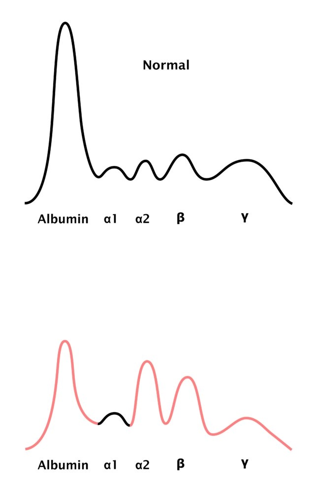 β1 = transferrin
β2 = β lipoprotein (LDL)

Now look at the image again. The albumin is ⤵️, α2 and β are ⤴️

It's either loss (or underproduction) of albumin and an ⤴️ production of lipoproteins and α2 components!

Can you join the dots and make the diagnosis?

5/16