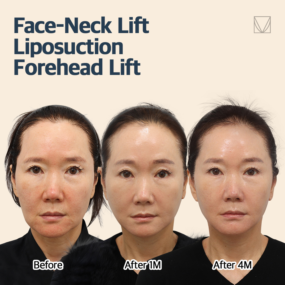 🩵Find out your V-line face with #vlif🩵

#Foreheadlifting #endoscopicforeheadlift #facelifting #facenecklift #necklift #undereyebags #smas #smaslifting #eyelidlift #saggy #saggyskin #droopyeyes #faceliftsurgery #boardcertifiedplasticsurgeon