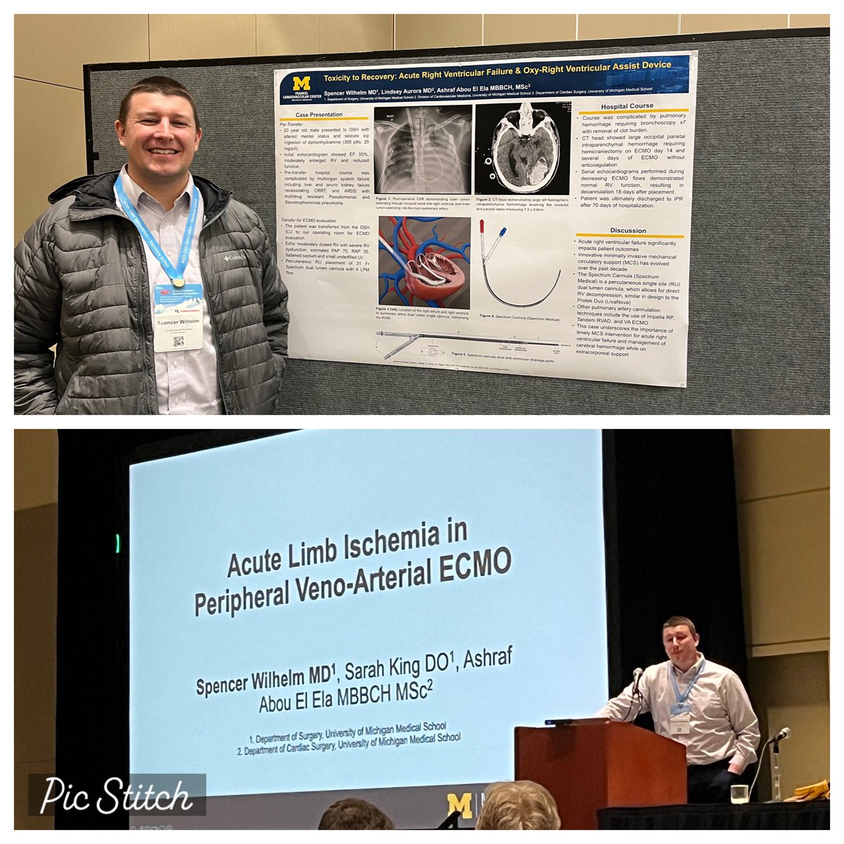 Last but not least, @WilhelmSpencerK with not one but TWO amazing presentations at #KeystoneECMO conference. Saving lives, and even legs, with innovative ECMO technologies and adjuncts. @UMPedsSurg @UMichSurgery