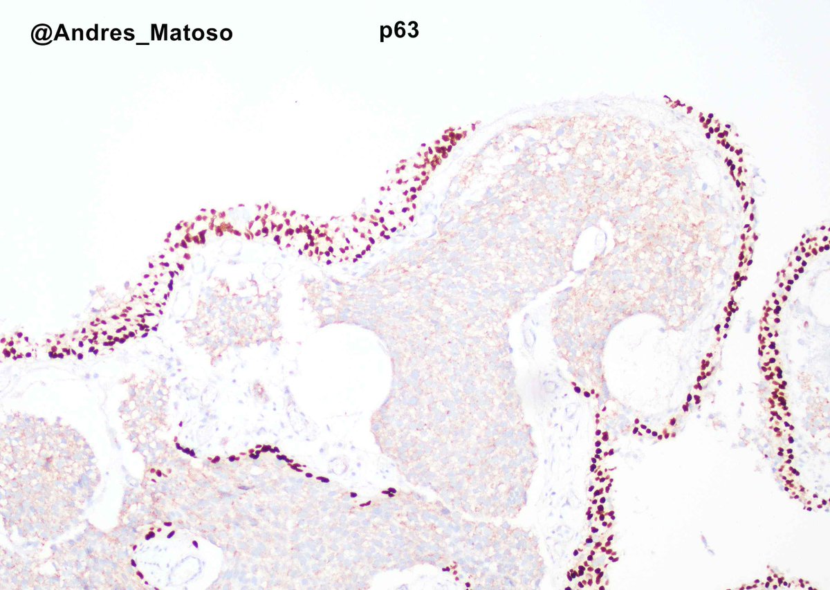 Andres_Matoso's tweet photo. Metastatic breast carcinoma to the bladder can mimic urothelial carcinoma. As with all secondary tumors, it is critical to have a high level of clinical suspicion and do the markers. Morphologic clue: tumor under normal urothelium, no CIS or papillary structures. #gupath https://t.co/LaWlZaJI44