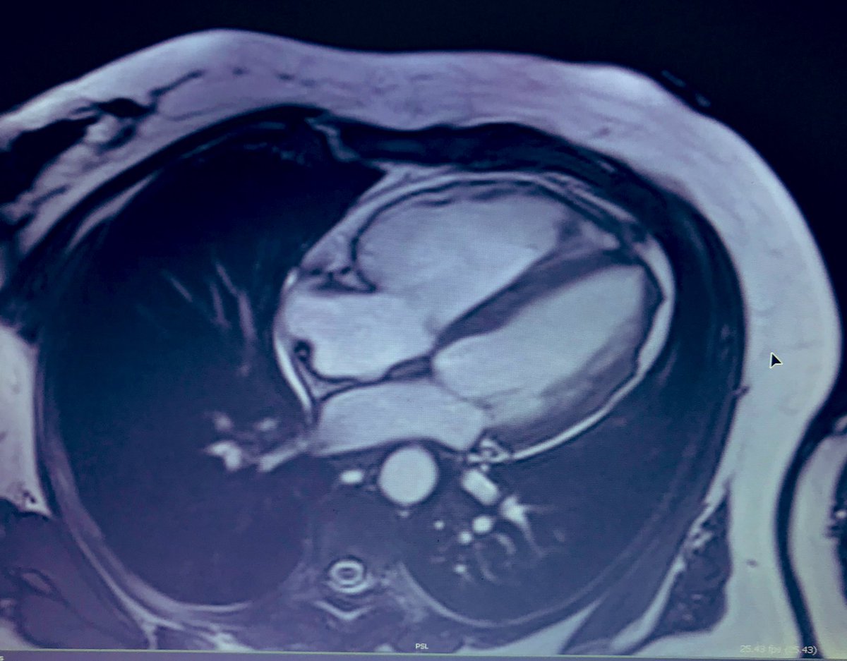 GrublerMartin's tweet photo. Young women with palpitations and high PVC burden (~15%/24h). Pt was referred to #cmr after 12 lead ekg showed TWI in V1-V4. #cmrfirst #foamed #Cardiology #arvc https://t.co/6wCdheYDaU