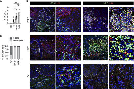 L-26 and trigger skin autoinflammation via activation of keratinocytes and concurrent killing of skin microbiota with formation of IL-26–DNA complexes that stimulate TLR9 @JExpMed @MGilliet @DomizioJeremy doi.org/10.1084/jem.20…