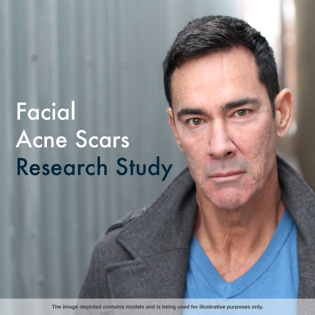 AcneScarStudy's tweet image. Facial acne scars are no reason to hide. Uncover more potential treatment options by participating in clinical research. Click to get started. dawnacnescarstudy.com