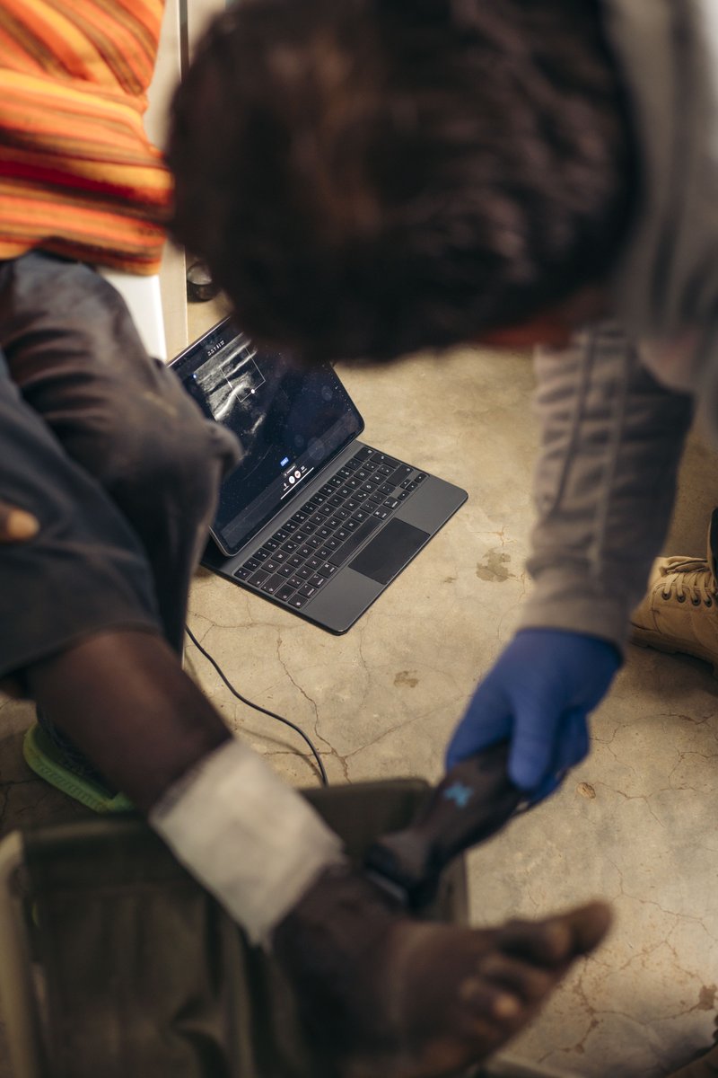 Our partners at Pflaster für Tansania use Butterfly to assess snakebites—an NTD that causes 20k annual deaths in Sub-Saharan Africa. Their innovative use monitors organ damage, aids bedside treatment, &amp; saves lives. We are proud to collaborate in expanding POCUS impact globally!