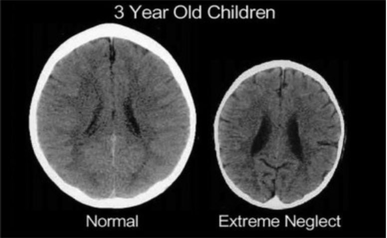 In this article we discuss the impact of health inequity on children and the steps we can take to address this inc. the Children and Young People's Health Equity Framework a practical tool to measure outcomes. 

sciencedirect.com/science/articl…
#HealthInequity #ChildPoverty #Paediatrics