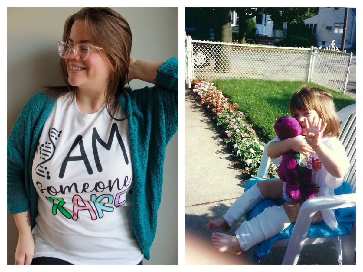 ShanStratton's tweet photo. It’s Rare Disease Day! 🦓 I was born with X-linked hypophosphatemia (XLH), a rare inherited disorder that affects the bones and teeth. It is characterized by low levels of the mineral phosphorus in the blood. Bones can become deformed, soft and easy to fracture. https://t.co/z46USJfSyd