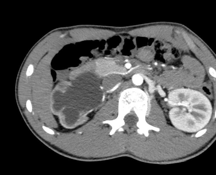 First report: #SinglePort robotic retroperitoneal nephrectomy in #pediatric patient. A single 3.5 cm incision to perform this #surgery and remove a hydronephrotic kidney in a child without entering the abdominal cavity. #somosCHUAC