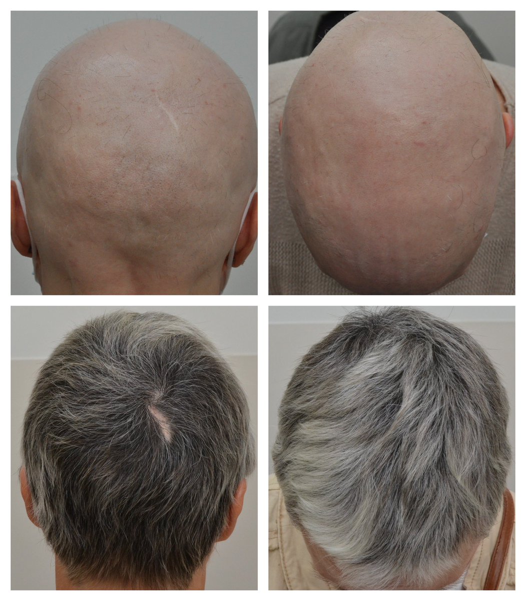 Life changing #hair regrowth in this 50-year-old woman with #alopecia areata following baricitinib #therapy 
#JAK inhibitors are making a huge difference to the lives of #alopeciaareata sufferers.
#dermatology #dermtwitter #hairloss