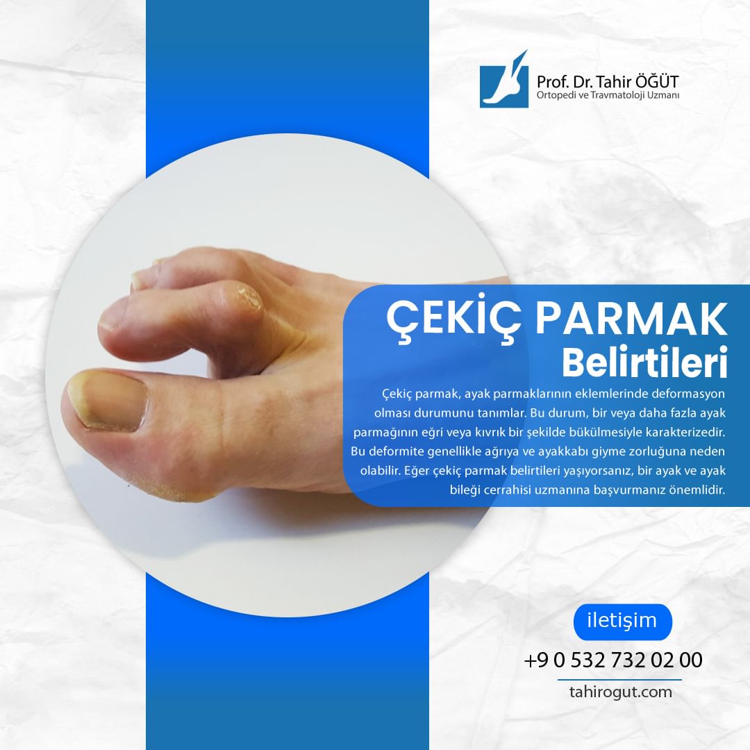 drtahirogut's tweet photo. 📍Çekiç Parmak

Çekiç parmak, ayak parmaklarının eklemlerinde deformasyon olması durumunu tanımlar. Bu durum, bir veya daha fazla ayak parmağının eğri veya kıvrık bir şekilde bükülmesiyle karakterizedir. Bu deformite genellikle ağrıya ve ayakkabı giyme zorluğuna neden olabilir. https://t.co/QC0K2RaXOD