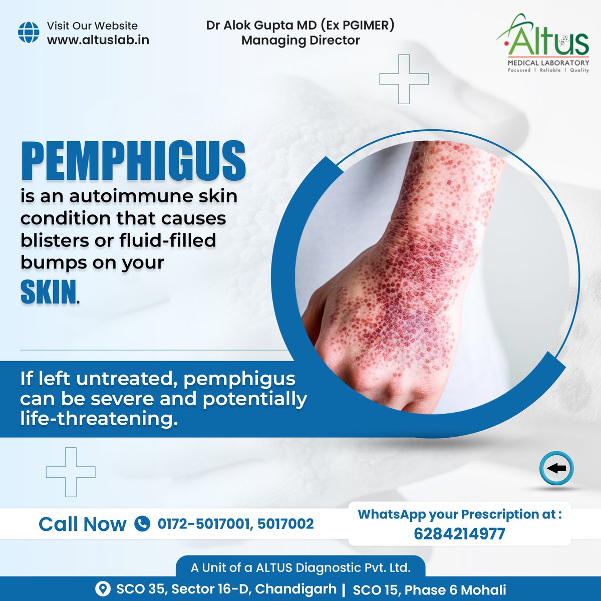 LabAltus's tweet image. #Pemphigus is an autoimmune disease in which the immune system mistakenly attacks cells in the top layer of the skin (epidermis) and the mucous membranes. People with the disease produce antibodies against desmogleins, proteins that bind skin cells to one another.

#altuslab