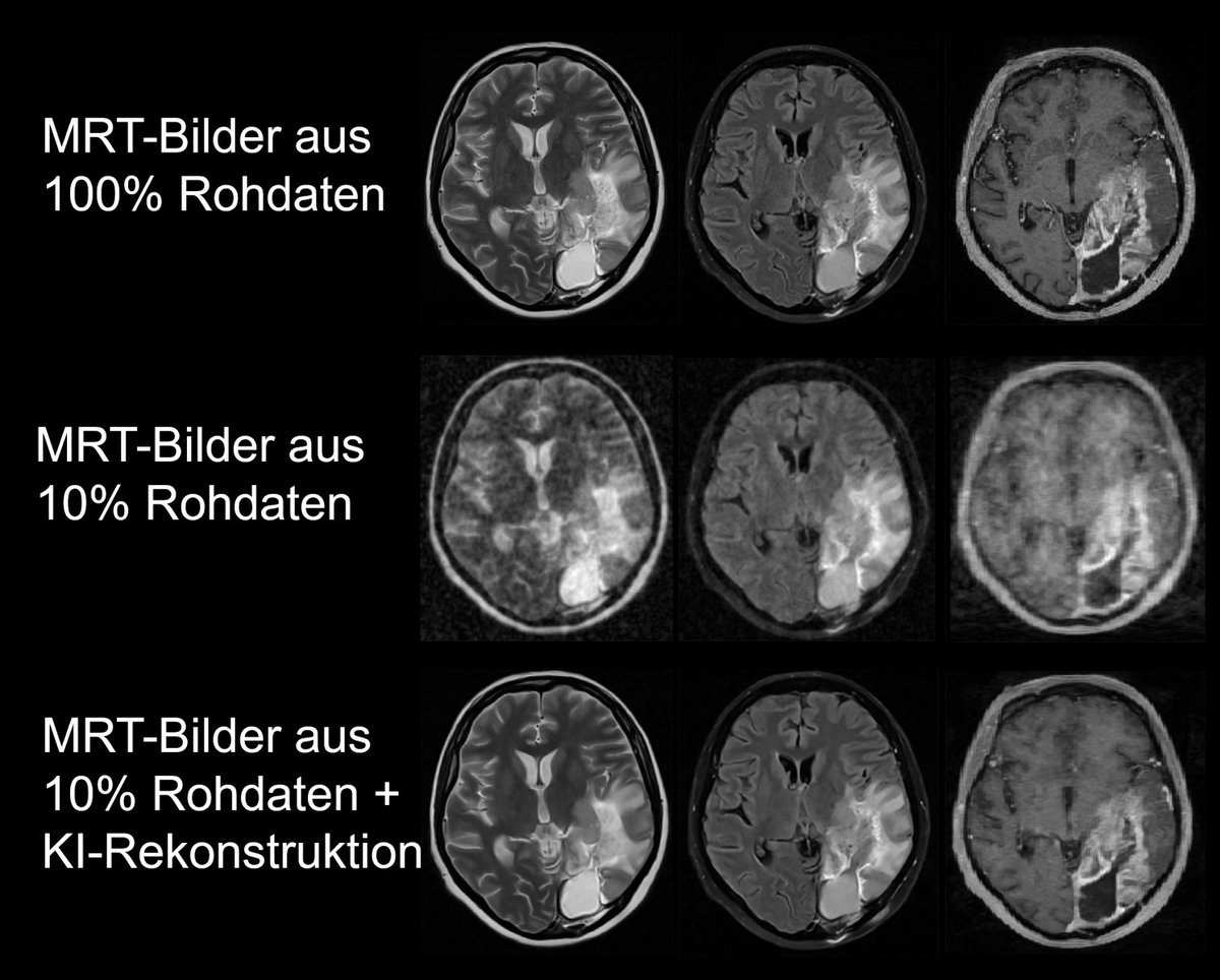 Mit #KI die Kernspin-Bildgebung beschleunigen – Wissenschaftler:innen von @UniHeidelberg, @DKFZ & #UKHD entwickelten mit Kooperationspartnern einen Algorithmus für die #MRT, der aus deutlich weniger Daten als bisher hochwertige Bilder erstellen kann. 👉 klinikum.uni-heidelberg.de/newsroom/mit-k…