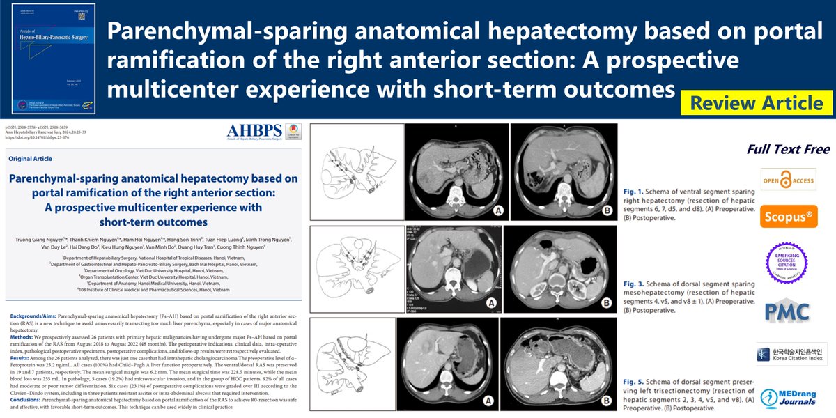 Parenchymal-sparing anatomical hepatectomy based on portal ramification of the right anterior section: A prospective multicenter experience with short-term outcomes 🌷doi.org/10.14701/ahbps… Truong Giang Nguyen #Anatomical_hepatectomy #Portal_ramification #Right_anterior_section