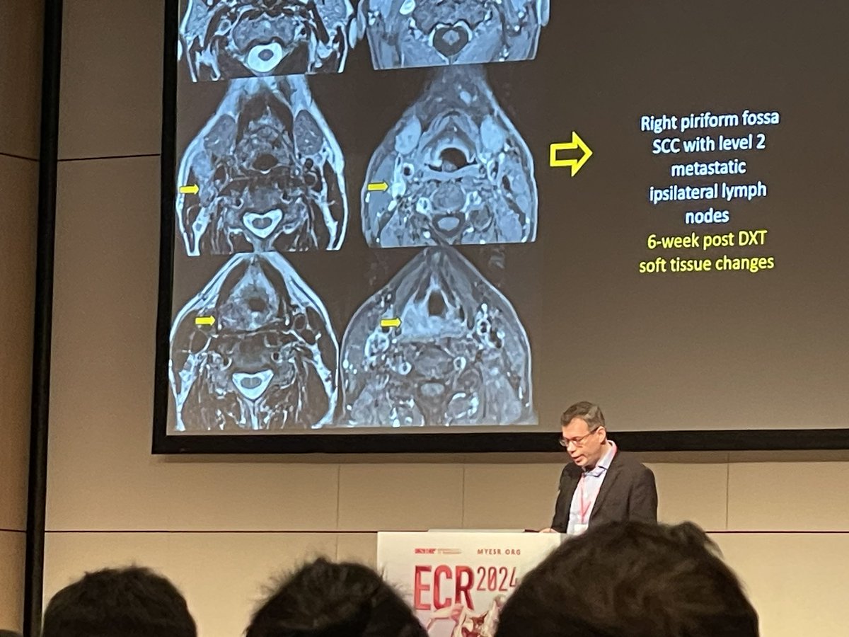 Welcome to Day 1 of #ECR2024 Make sure to have a look at the head&neck lectures held by many renowned speakers from allover the 🌍 @SEJConnor lecturing on H&N cancer after chemoradiation therapy @ASHNRSociety @YPekcevik @AnnePeporte @jussihirvonen