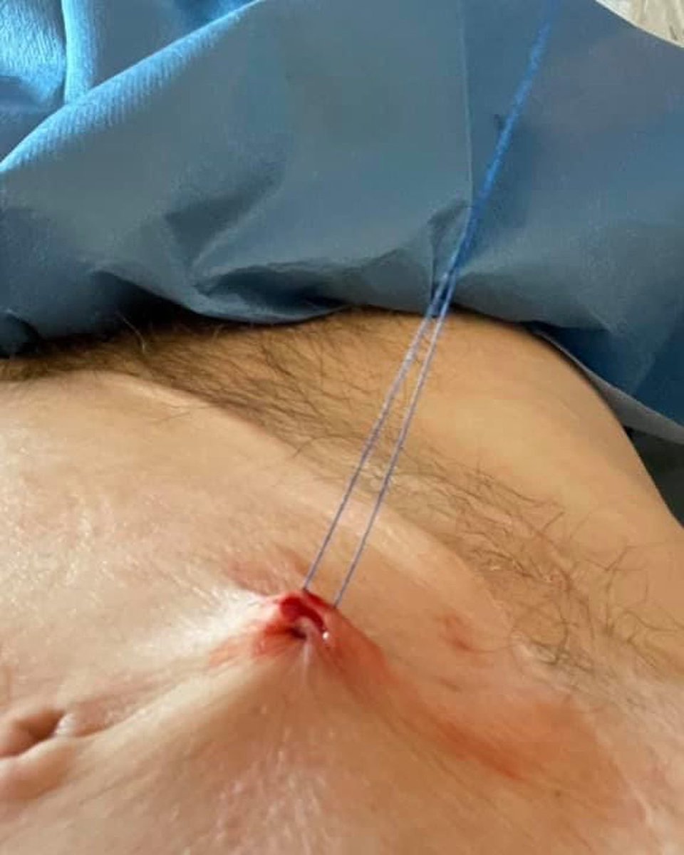 Adam Alderson (@adamalderson3) on Twitter photo Did you know my abdominal wall skin graft gives me information of any early rejection ? Now with the team <a href="/OxTxResearch/">Oxford Transplant Research</a> we look to see if skin grafts do the same in heart and lung patients #interesting #organdonation #organtransplant #surgery #medicalresearch <a href="/BasingstokePmi/">PMI Basingstoke</a> Did you know my abdominal wall skin graft gives me information of any early rejection ? Now with the team <a href="/OxTxResearch/">Oxford Transplant Research</a> we look to see if skin grafts do the same in heart and lung patients #interesting #organdonation #organtransplant #surgery #medicalresearch <a href="/BasingstokePmi/">PMI Basingstoke</a>