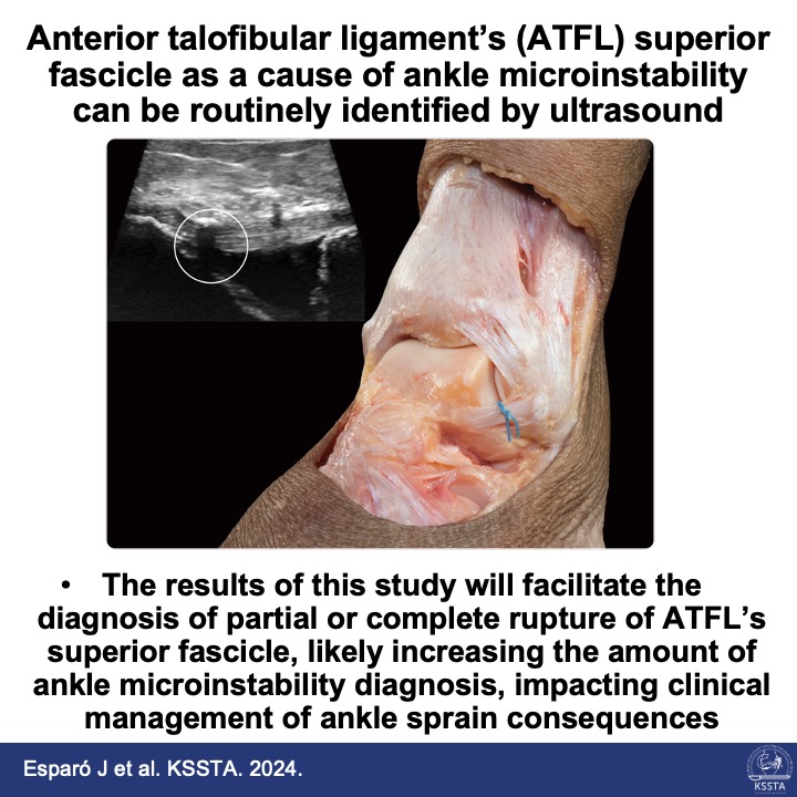 The anterior tibiofibular ligament‘s(ATFL) superior fascicle is responsible for micro instability after an ankle sprain. Read more on this study!

#ankle #microinstability #ultrasound #ATFL #orthopaedics  #sportsmedicine #anatomy

Find out more here: doi.org/10.1002/ksa.12…