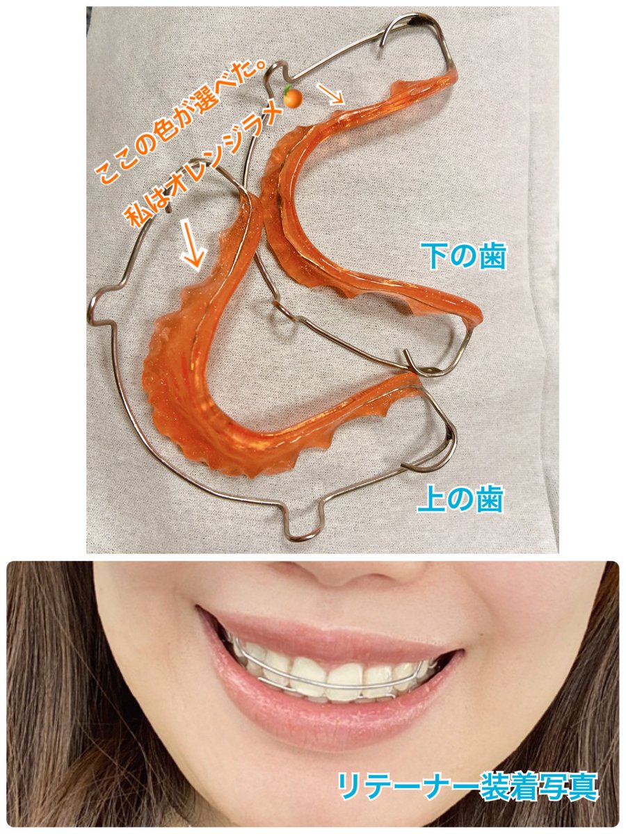 リテーナーの紹介②🦷
⭐️ベッグリテーナー
・目立つ。矯正知らない人からはリテーナーじゃなくて矯正装着だと思われる
・飲食⭕️（飲み物は大丈夫だけど、食べ物は食べづらいから外してる）
・滑舌悪くなる。マウスピースの方が全然話しやすい
・外してる時は水中保管（🍊の所が乾くと割れやすい）