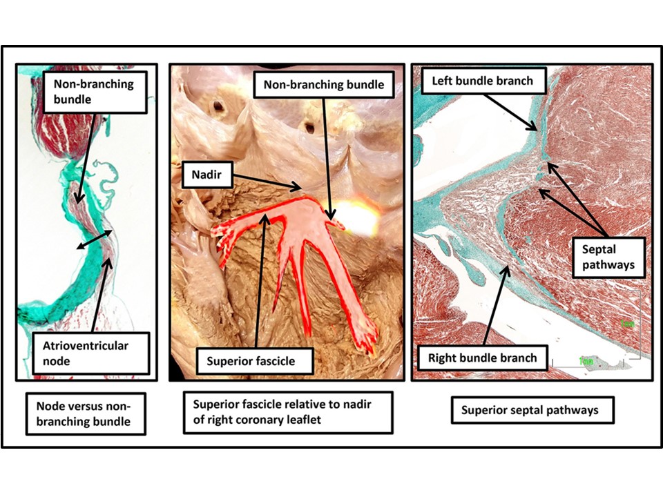 The clinical anatomy of the atrioventricular conduction axis 👉 bit.ly/49jmseZ @EuropaceEiC @GiulioConte9 @Dominik_Linz @FraSantoroMD @AndyZhangMD @marcovitoloMD @MBergonti #Europace #PM #arrhythmias #AV