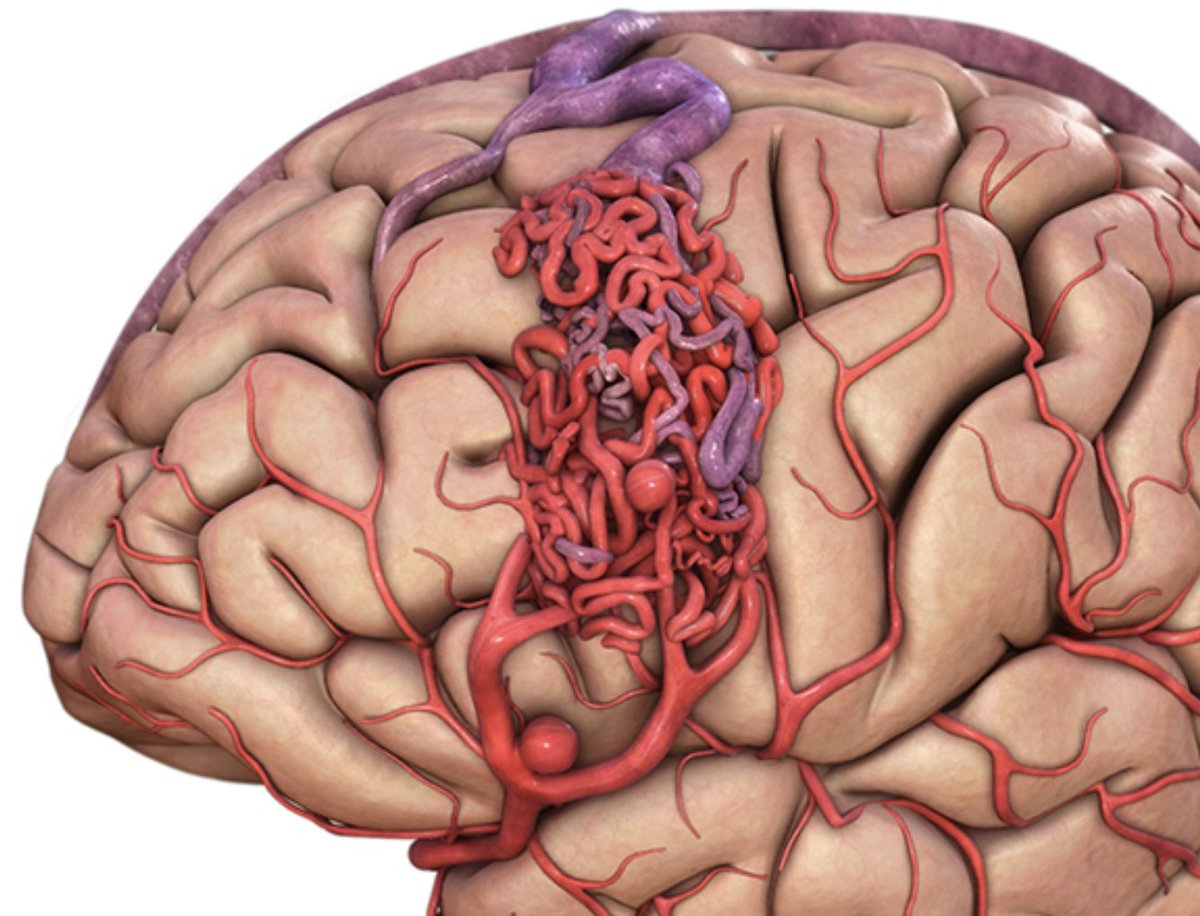 ...As neurosurgery combines surgical science &amp; athleticism, so is neurosurgical influence becoming a combination of academic contributions &amp; technical excellence. We all need mentors beyond our faculty &amp; can find them thru videos comprising a “virtual residency” that can educate