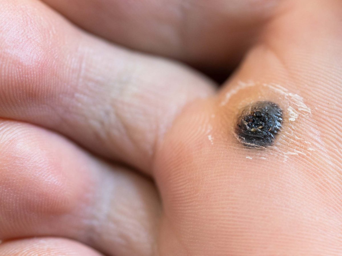 PodiatryMidwest's tweet image. Step into comfort with Swift! Tired of plantar wart troubles? Our advanced treatment offers painless removal with no scarring or downtime. Walk out of each session with healthier, happier feet! #FootComfort #SwiftRelief
bit.ly/3e2KwaP