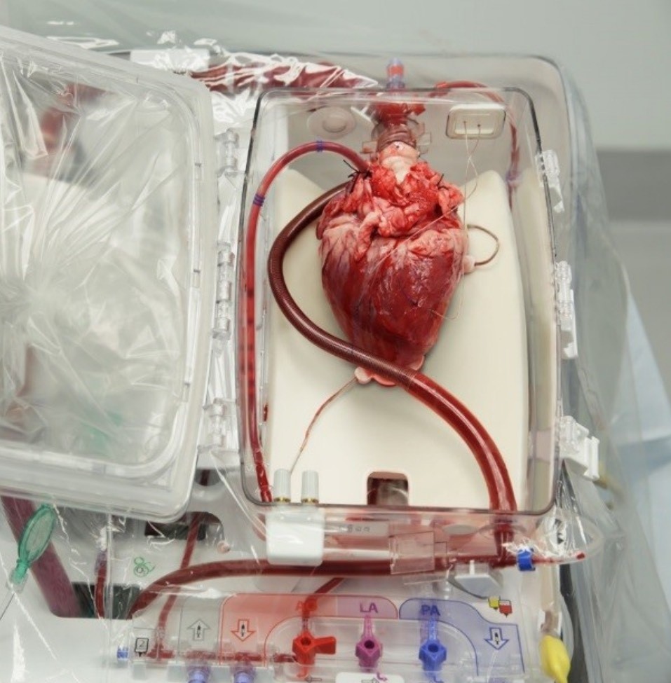 BSLMC recently performed their first heart transplantation from a donation after cardiac death donor (DCD). We are very pleased that the recipient is doing extremely well. Congratulations to the entire team including Drs. Liao, Shafii, Mattar, Senussi, Nair, Simpson &amp; Civitello.