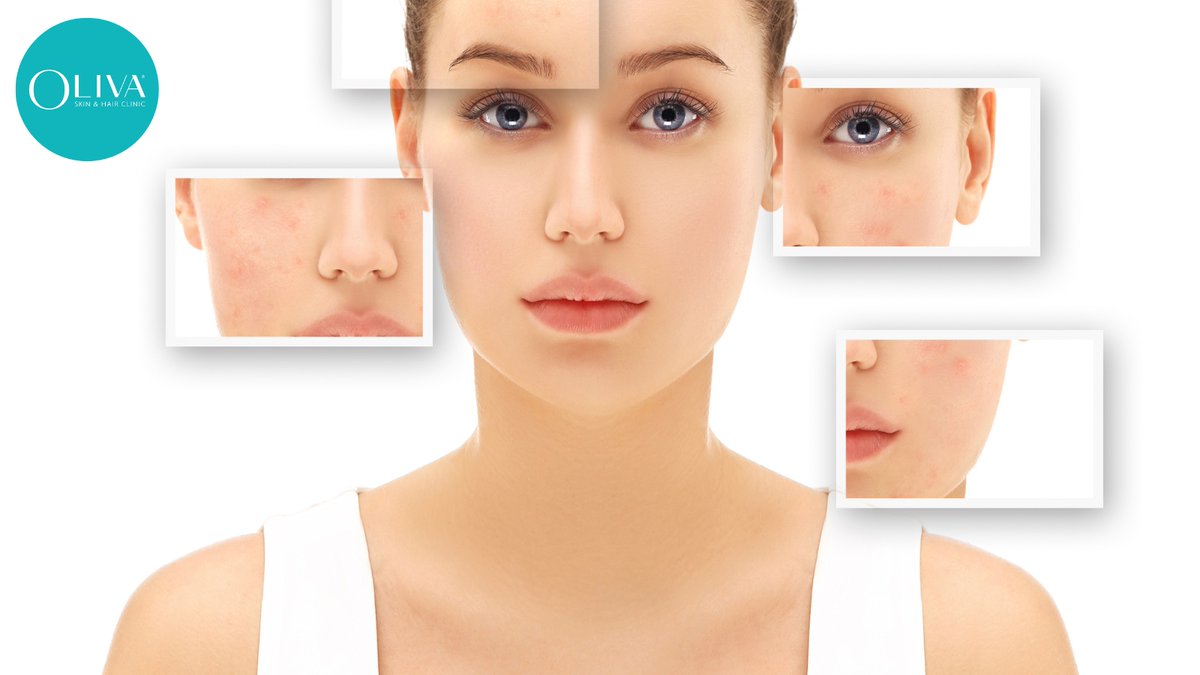 olivaclinic's tweet image. Acne comes in various forms, each presenting its own challenges. From blackheads and whiteheads to inflammatory papules and cysts. Click the link below to know the different types of acne causes and treatments

shorturl.at/acgmD

#AcneAwareness  #PimpleProblems #AdultAcne