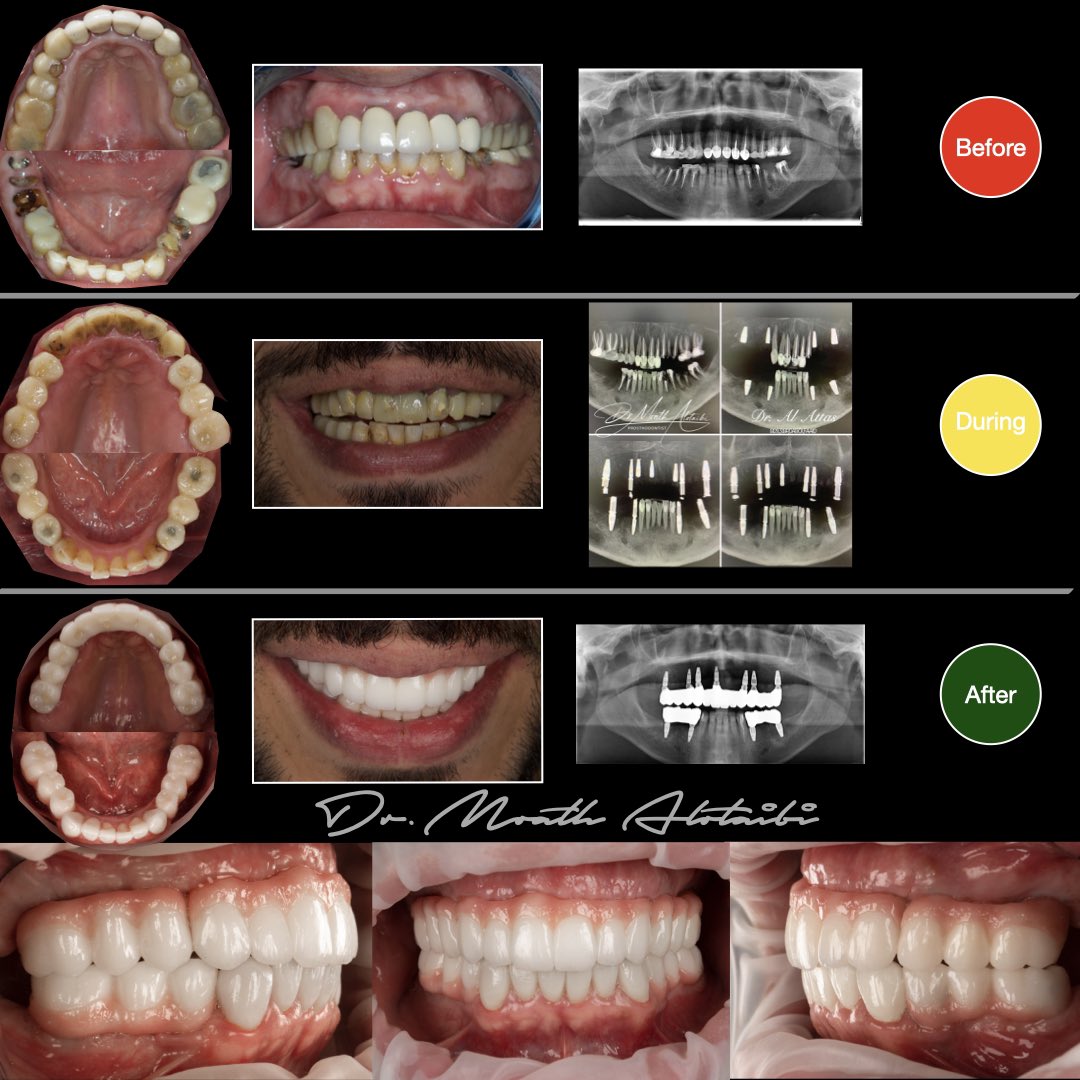 اعادة تأهيل كامل للفم عن طريق ١١ زرعة 
وجسور لتركيبات الزركونيا المنفصله

تمت الزراعة الفوريه في هذه الحالة على مراحل:
-ابتداءا بخلع الاسنان الخلفيه (العلويه والسفليه) وتركيب المؤقت عليهم
-بعد الالتئام للجزء الخلفي تم خلع الاسنان الاماميه وتعويضها بالزراعه والتركيبات المؤقته