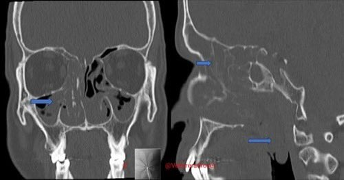 VelloreRadRover's tweet photo. Case #10 answer: 

Answer slide: Maxillary sinus: Polypoidal mass with mucin density in the right maxillary sinus extending via the middle meatus to the right nasal cavity, this lesion is indistinguishable from the polypoidal mass with striated calcifications https://t.co/YmfBTtrKrm