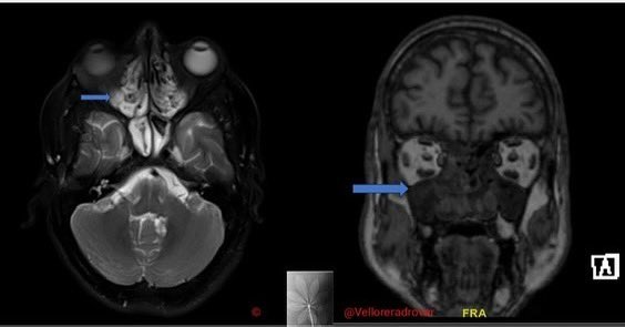 VelloreRadRover's tweet photo. Case #10 answer: 

Answer slide: Maxillary sinus: Polypoidal mass with mucin density in the right maxillary sinus extending via the middle meatus to the right nasal cavity, this lesion is indistinguishable from the polypoidal mass with striated calcifications https://t.co/YmfBTtrKrm