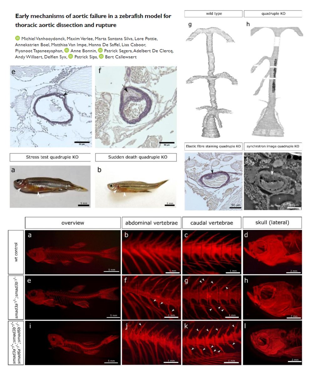 An adult (6 mpf) #Zebrafish model of #AorticDissection #AorticRupture (without #AorticAneurysm)
Quadriple smad3a/3b/smad6a/6b crispant

🐟Aortic #FalseLumen for 1st time 👏👏👏

⏬Aortic diameter+length
⏫Aortic tortuosity
Aortic wall thinning + Elastin loss + subendothelial