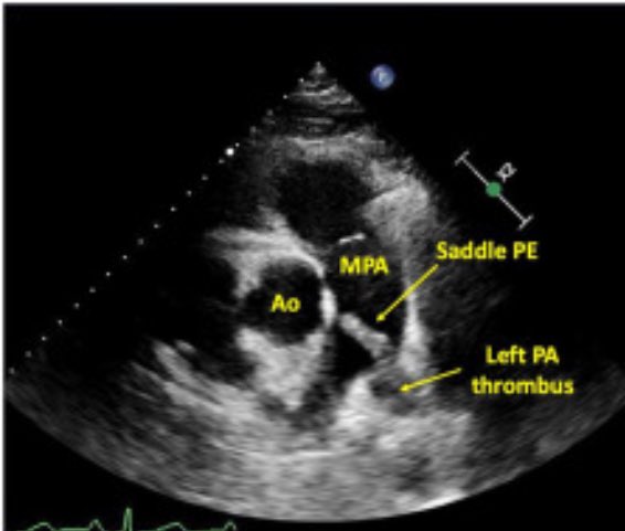 jameshorowitzmd's tweet photo. 💥Is your #STEMI team missing significant  #PE ? 🫁

Maybe! 

Read below from @cardsnyc: when to suspect PE &amp; maybe, just maybe catch it w #echofirst !

https://t.co/PspKTe79pb

And save the date 10.25.24 https://t.co/kTJLsQiaYG
@ASE360 @CASEfromASE @btaslakianMD @PERTConsortium https://t.co/MMQIVBDIm6