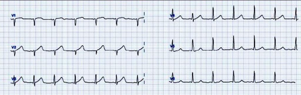 OnlyEcg1's tweet image. CP. Dx?

#Cardiology #MedstudentTwitter #MedTwitter #CardioTwitter #CardioEd #ECG #EKG #STEMI #OMI #cardiovascular #medicalstudent #MedicalEmergency #paramedic #cardiologist #cathlab