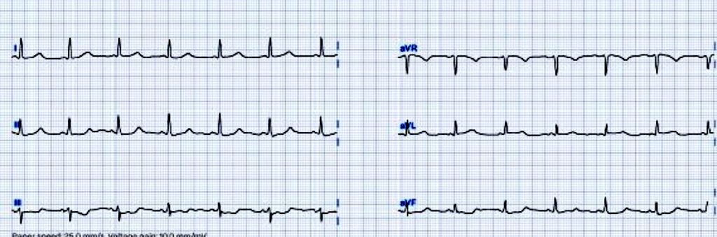 CP. Dx?

#Cardiology #MedstudentTwitter #MedTwitter #CardioTwitter #CardioEd #ECG #EKG #STEMI #OMI #cardiovascular #medicalstudent #MedicalEmergency #paramedic #cardiologist #cathlab