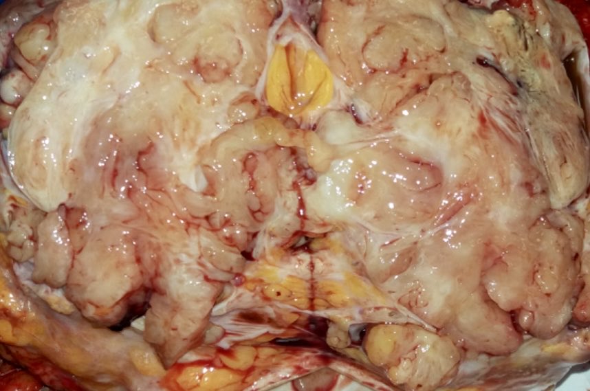 vintage81106614's tweet image. The art of grossing. A 56 yo woman with palpable left breast tumor which was proven to be “fibroepithelial tumor”on histology. Final DX.Left Total Mastectomy: 12x9 cm, Borderline Phyllodes Tumor. #pathology #pathres #pathTwitter #Breast #Cancer