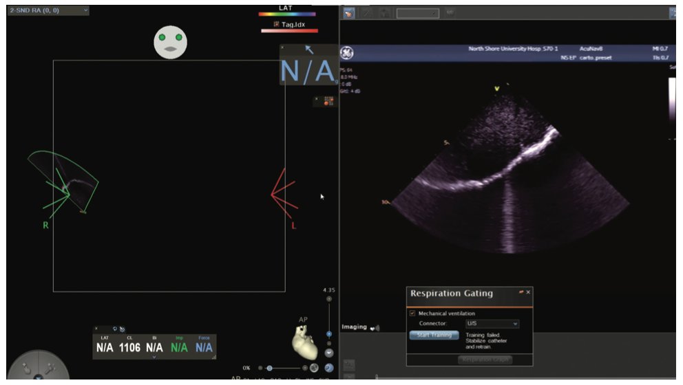 The Hitchhiker’s Guide to Zero Fluoroscopy Catheter Ablation @RLMitraMDPhD discusses his approach to zero-fluoroscopy ablation for all endovascular EP procedures, including atrial fibrillation and ventricular tachycardia ablation. okt.to/hixHKD #EPeeps