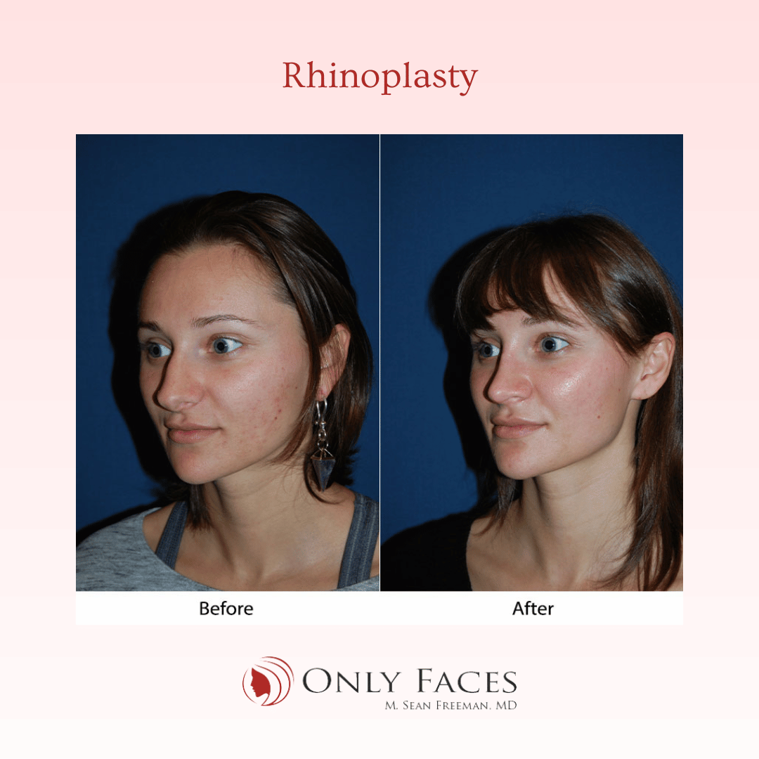 OnlyFacesCLT's tweet photo. This 24-year-old is 2 months post-op from a #Rhinoplasty. #OnlyFaces https://t.co/Jvs0hqBnLj