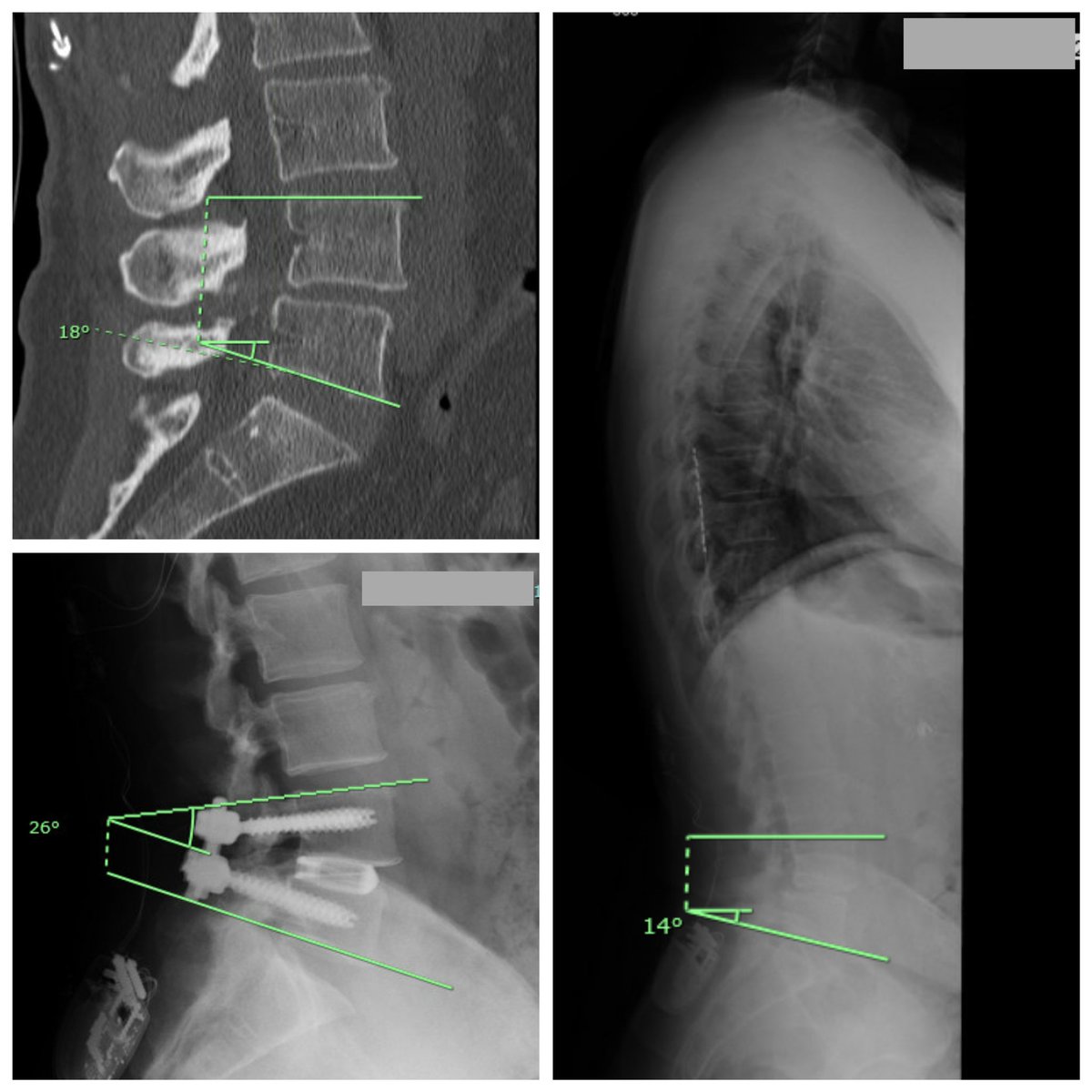AliBaajMD's tweet photo. Procedures do not cause kyphosis.
Technique causes kyphosis.
#TLIF https://t.co/UU0JdIE0Kc