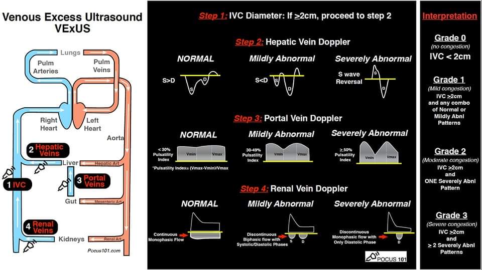 🔴 Roadblocks to Diuresis: Cardiorenal 
2024 #NephMadness visual abstracts

💥Mechanisms of Diuretic Resistance and Diuretic Resistance Treatments 

💥Cardiac Biomarkers in CKD vs Kidney Biomarkers in CHF

ajkdblog.org/2022/03/01/nep…